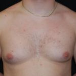 Gynecomastia Before & After Patient #21222