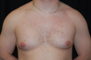 Gynecomastia Before & After Patient #21222