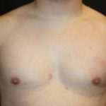 Gynecomastia Before & After Patient #21222