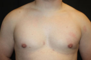 Gynecomastia Before & After Patient #21222