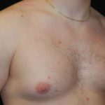 Gynecomastia Before & After Patient #21222