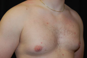 Gynecomastia Before & After Patient #21222