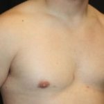 Gynecomastia Before & After Patient #21222