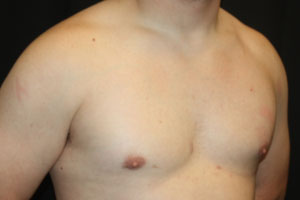 Gynecomastia Before & After Patient #21222