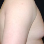 Gynecomastia Before & After Patient #21222