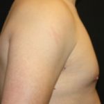 Gynecomastia Before & After Patient #21222