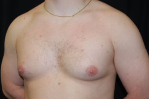 Gynecomastia Before & After Patient #21222