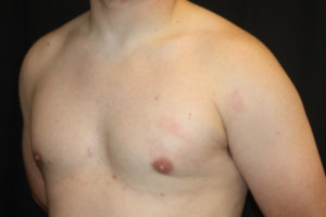 Gynecomastia Before & After Patient #21222