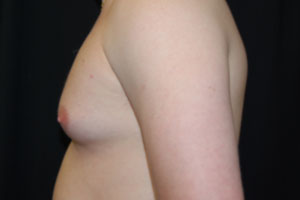 Gynecomastia Before & After Patient #21222