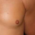 Gynecomastia Before & After Patient #23416