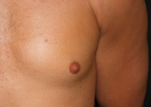 Gynecomastia Before & After Patient #23416