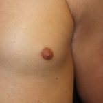 Gynecomastia Before & After Patient #23416