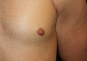 Gynecomastia Before & After Patient #23416