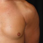 Gynecomastia Before & After Patient #23416