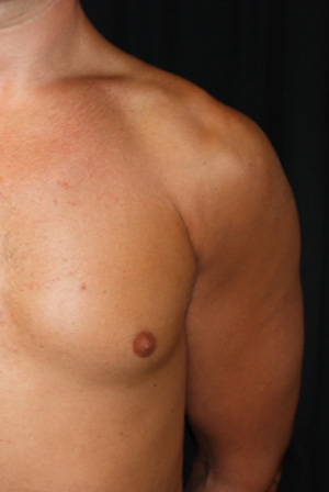 Gynecomastia Before & After Patient #23416