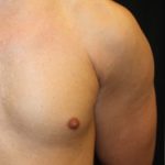 Gynecomastia Before & After Patient #23416