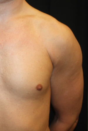 Gynecomastia Before & After Patient #23416