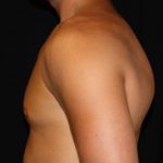 Gynecomastia Before & After Patient #23416