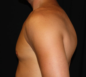 Gynecomastia Before & After Patient #23416