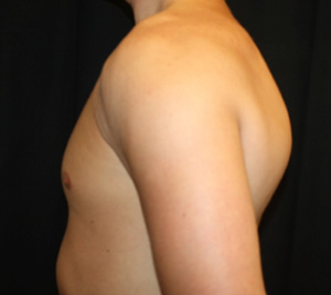 Gynecomastia Before & After Patient #23416