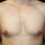 Gynecomastia Before & After Patient #23431