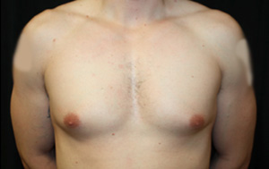 Gynecomastia Before & After Patient #23431