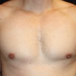 Gynecomastia Before & After Patient #23431