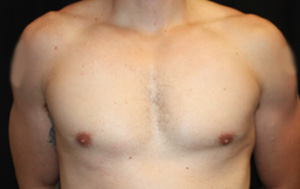 Gynecomastia Before & After Patient #23431