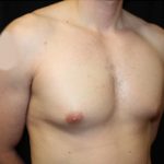 Gynecomastia Before & After Patient #23431