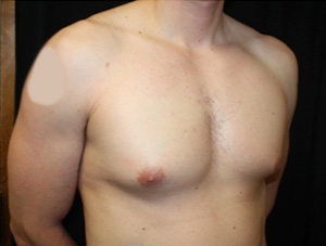 Gynecomastia Before & After Patient #23431