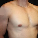 Gynecomastia Before & After Patient #23431