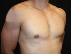 Gynecomastia Before & After Patient #23431