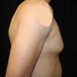 Gynecomastia Before & After Patient #23431