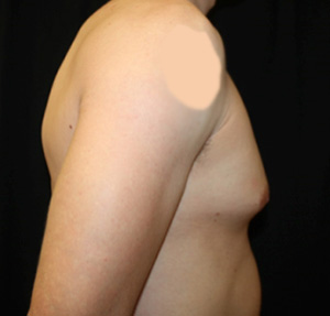 Gynecomastia Before & After Patient #23431