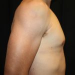 Gynecomastia Before & After Patient #23431