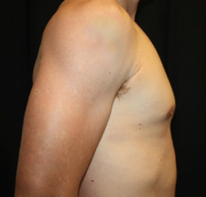 Gynecomastia Before & After Patient #23431