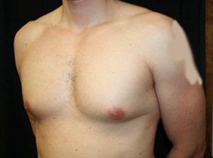 Gynecomastia Before & After Patient #23431