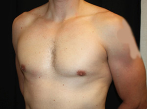 Gynecomastia Before & After Patient #23431