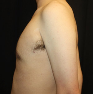 Gynecomastia Before & After Patient #23434