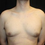 Gynecomastia Before & After Patient #23434