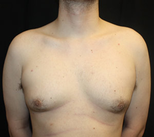 Gynecomastia Before & After Patient #23434