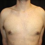 Gynecomastia Before & After Patient #23434