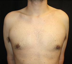 Gynecomastia Before & After Patient #23434