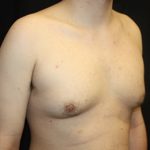 Gynecomastia Before & After Patient #23434