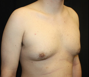 Gynecomastia Before & After Patient #23434