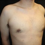 Gynecomastia Before & After Patient #23434