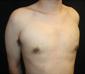 Gynecomastia Before & After Patient #23434