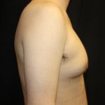 Gynecomastia Before & After Patient #23434