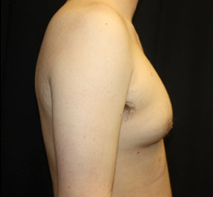 Gynecomastia Before & After Patient #23434