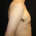 Gynecomastia Before & After Patient #23434